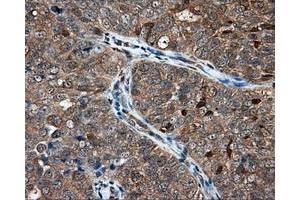 Immunohistochemical staining of paraffin-embedded Adenocarcinoma of ovary tissue using anti-NIT1 mouse monoclonal antibody. (Nitrilase 1 anticorps)