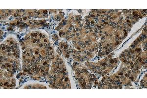Immunohistochemistry of paraffin-embedded Human breast cancer tissue using DNA Ligase1 Polyclonal Antibody at dilution 1:70 (LIG1 anticorps)
