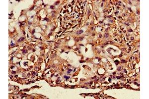Immunohistochemistry of paraffin-embedded human lung cancer using ABIN7145421 at dilution of 1:100