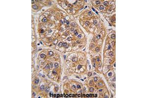 Formalin-fixed and paraffin-embedded human hepatocarcinomareacted with AKR1A1 polyclonal antibody , which was peroxidase-conjugated to the secondary antibody, followed by AEC staining. (AKR1A1 anticorps  (C-Term))
