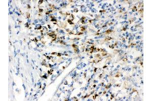 IHC(P): Human Intestinal Cancer Tissue