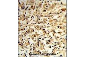 Forlin-fixed and paraffin-embedded hun breast carcino reacted with T2B Antibody (N-term), which was peroxidase-conjugated to the secondary antibody, followed by DAB staining. (MAT2B anticorps  (N-Term))