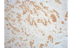 IHC staining of mouse prostate adenocarcinoma tissue, diluted at 1:200. (AMACR anticorps)