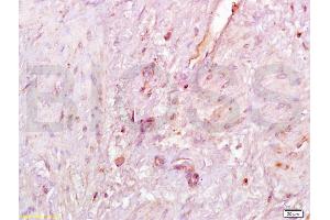 Formalin-fixed and paraffin embedded human endometrial carcinoma labeled with Anti-SIRT1 Polyclonal Antibody, Unconjugated (ABIN729853) at 1:200, followed by conjugation to the secondary antibody and DAB staining (SIRT1 anticorps  (AA 101-200))
