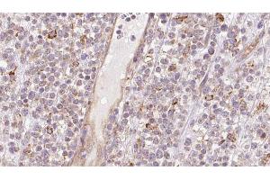 ABIN6273205 at 1/100 staining Human lymph cancer tissue by IHC-P. (CCBL1 anticorps  (Internal Region))