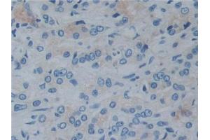 DAB staining on IHC-P;;Samples: Human Prostate cancer Tissue