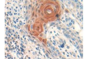DAB staining on IHC-P; Samples: Human Skin cancer Tissue (Follistatin anticorps  (AA 35-283))