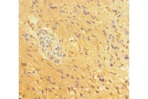 Immunohistochemistry of paraffin-embedded human glioma using ABIN7164055 at dilution of 1:100 (POU3F2 anticorps  (AA 1-443))