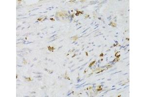 Immunohistochemistry of paraffin-embedded Human adenomyosis using LSP1 Polyclonal Antibody at dilution of 1:100 (40x lens). (LSP1 anticorps)