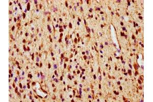 IHC image of ABIN7160224 diluted at 1:600 and staining in paraffin-embedded human glioma performed on a Leica BondTM system.