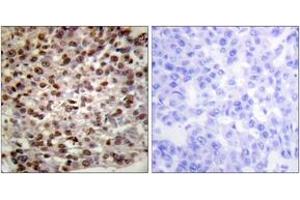 Immunohistochemistry analysis of paraffin-embedded human breast carcinoma tissue, using Histone H2B (Acetyl-Lys15) Antibody. (Histone H2B anticorps  (acLys15))