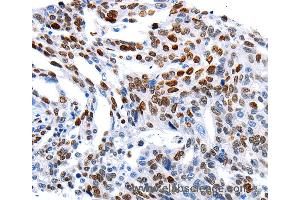 Immunohistochemistry of Human ovarian cancer using MUTYH Polyclonal Antibody at dilution of 1:60 (MUTYH anticorps)