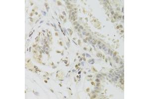 Immunohistochemistry of paraffin-embedded human breast using PRPF3 Antibody (ABIN5973192) at dilution of 1/100 (40x lens). (PRPF3 anticorps)