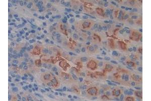 IHC-P analysis of Human Stomach cancer Tissue, with DAB staining. (SLC3A2 anticorps  (AA 213-349))