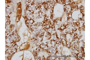 Immunoperoxidase of monoclonal antibody to SERPINA3 on formalin-fixed paraffin-embedded human ovary, clear cell carcinoma.
