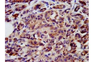 IHC image of ABIN7169389 diluted at 1:200 and staining in paraffin-embedded human pancreatic cancer performed on a Leica BondTM system.