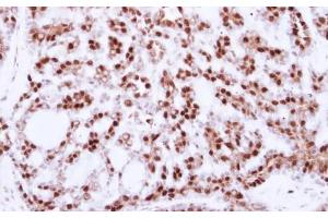 IHC-P Image Immunohistochemical analysis of paraffin-embedded human breast cancer, using CDC25C, antibody at 1:250 dilution. (CDC25C anticorps)