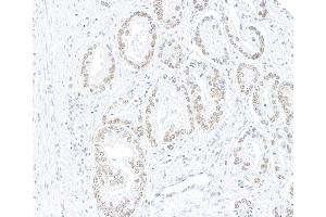 Immunohistochemistry (IHC) image for anti-AT Rich Interactive Domain 1A (SWI-Like) (ARID1A) (AA 750-800) antibody (ABIN7795677) (Recombinant ARID1A anticorps  (AA 750-800))