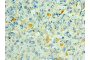 Immunohistochemistry of paraffin-embedded human melanoma using ABIN7169519 at dilution of 1:100 (SHC4 anticorps  (AA 1-185))