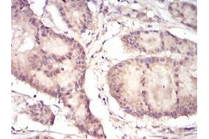 Immunohistochemical analysis of paraffin-embedded colon cancer tissues using EIF5A mouse mAb with DAB staining.
