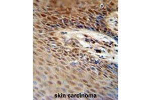 ZNF324B antibody (C-term) immunohistochemistry analysis in formalin fixed and paraffin embedded human skin carcinoma followed by peroxidase conjugation of the secondary antibody and DAB staining. (ZNF324B anticorps  (C-Term))