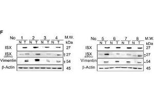 The expression of ISX, BRD4, and PCAF is correlated with lung cancer metastasisAIHC staining with ISX (brown) or PCAF (brown) antibody in lung tumors from patients with lung cancer. (Vimentin anticorps)