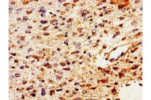 Immunohistochemistry of paraffin-embedded human glioma using ABIN7163691 at dilution of 1:100