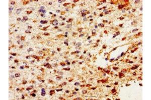 Immunohistochemistry of paraffin-embedded human glioma using ABIN7163691 at dilution of 1:100 (Pleiotrophin anticorps  (AA 33-168))