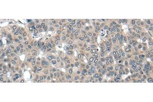 Immunohistochemistry of paraffin-embedded Human liver cancer tissue using CARD16 Polyclonal Antibody at dilution of 1:55(x200) (CARD16 anticorps)