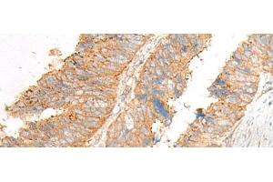 Immunohistochemistry of paraffin-embedded Human colorectal cancer tissue using GLIS1 Polyclonal Antibody at dilution of 1:50(x200)