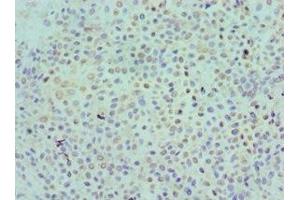 Immunohistochemistry of paraffin-embedded human breast cancer using ABIN7157519 at dilution of 1:100