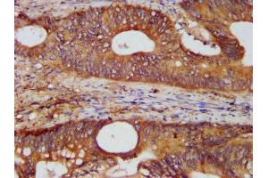 IHC image of ABIN7157562 diluted at 1:400 and staining in paraffin-embedded human colon cancer performed on a Leica BondTM system. (KTN1 anticorps  (AA 978-1116))