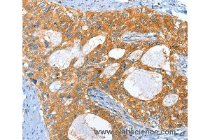 Immunohistochemistry of Human lung cancer using AMHR2 Polyclonal Antibody at dilution of 1:40 (AMHR2 anticorps)