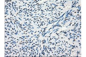 Immunohistochemical staining of paraffin-embedded Adenocarcinoma of colon tissue using anti-FRKmouse monoclonal antibody. (FRK anticorps)