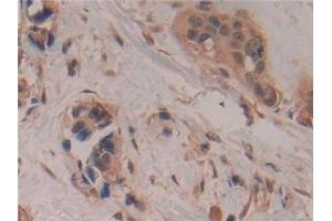 Detection of GAP43 in Human Breast cancer Tissue using Polyclonal Antibody to Growth Associated Protein 43 (GAP43)