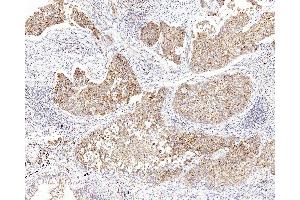 Immunohistochemistry analysis of paraffin-embedded human lung cancer using CYCS Polyclonal Antibody at dilution of 1:1000. (Cytochrome C anticorps)