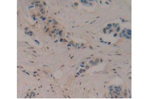 DAB staining on IHC-P Samples:Human Breast Cancer Tissue) (ENO2/NSE anticorps  (AA 1-434))
