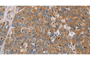 Immunohistochemistry of paraffin-embedded Human esophagus cancer using ACTN4 Polyclonal Antibody at dilution of 1:60 (alpha Actinin 4 anticorps)