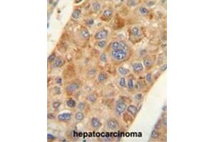 AMACR antibody (C-term) immunohistochemistry analysis in formalin fixed and paraffin embedded human hepatocarcinoma followed by peroxidase conjugation of the secondary antibody and DAB staining.