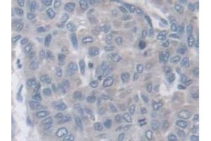 Detection of ARPC2 in Human Liver cancer Tissue using Polyclonal Antibody to Actin Related Protein 2/3 Complex Subunit 2 (ARPC2)