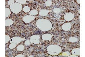 Immunoperoxidase of monoclonal antibody to HLA-DMA on formalin-fixed paraffin-embedded human malignant lymphoma, diffuse large B tissue.