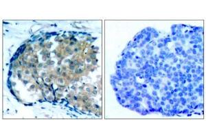 Immunohistochemical analysis of paraffin-embedded human breast carcinoma tissue, using Ezrin (phospho-Tyr353) antibody (E011063). (Ezrin anticorps  (pTyr353))