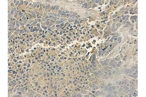 ABIN6255799 and ABIN6277803 at 1/100 staining human large cell lung carcinoma by IHC-P.