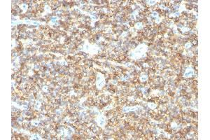 Formalin-fixed, paraffin-embedded human Ewing's Sarcoma stained with CD99 Mouse Monoclonal Antibody (HO36-1. (CD99 anticorps)