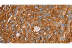Immunohistochemistry of paraffin-embedded Human breast cancer using PAICS Polyclonal Antibody at dilution of 1:35 (PAICS anticorps)