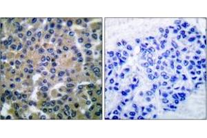Immunohistochemistry analysis of paraffin-embedded human breast carcinoma tissue, using SYK (Ab-348) Antibody. (SYK anticorps  (AA 314-363))
