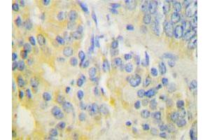 Immunohistochemical analysis of paraffin-embedded human prostate cancer tissue using CYP24A1 polyclonal antibody .