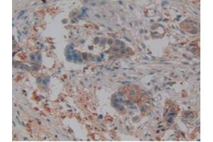 IHC-P analysis of Human Pancreas Cancer Tissue, with DAB staining. (Lipocalin 2 anticorps  (AA 21-198))