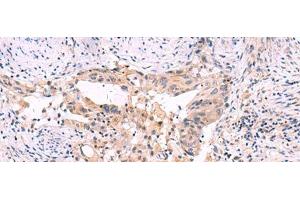 Immunohistochemistry of paraffin-embedded Human cervical cancer tissue using SLC12A5 Polyclonal Antibody at dilution of 1:40(x200) (KCC2 anticorps)