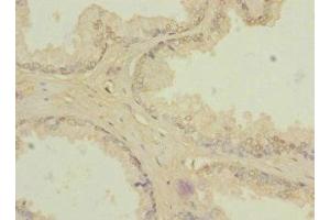 Immunohistochemistry of paraffin-embedded human prostate cancer using ABIN7176633 at dilution of 1:100 (ZIC3 anticorps  (AA 1-240))